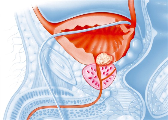 Rakovina prostaty, kter je na obrzku uprosted, postihuje pedevm mue po...