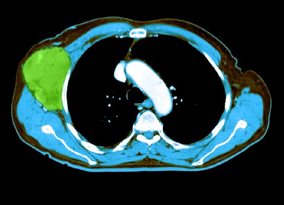 Na CT snímku pacienta s Non-Hodgkinovým lymfomem je zelen zvýraznn nádor.
