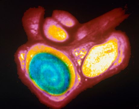 Snímek nádoru varlete (ilustraní fotografie)
