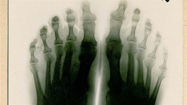 Jeden z dochovanch Dreuschuchovch snmk nohou z potk rentgenologie na Morav.