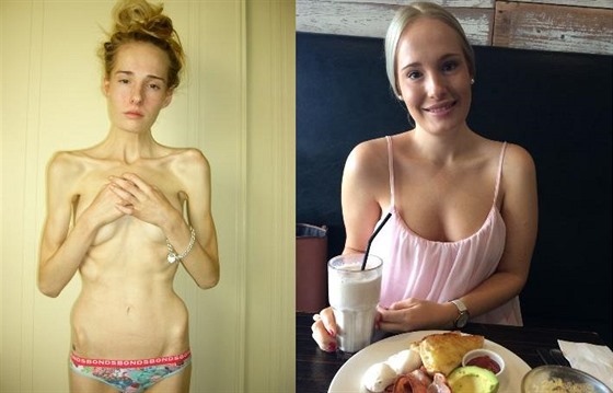 Gemma Walkerová v dob, kdy mla anorexii a dnes.