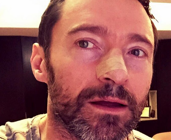 Hugh Jackman oznámil, e se mu u popáté vrátila rakovina ke (8. února 2016).