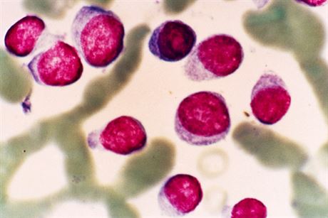 Snímek plazmatických bunk u pacienta s mnohoetným myelomem.