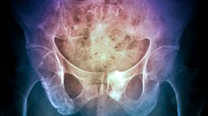 Snímek pánve pacienta s mnohočetným myelomem. Maligní (rakovinné) léze kosti... Snímek pánve pacienta s mnohočetným myelomem. Maligní (rakovinné) léze kosti...