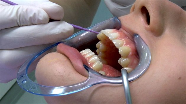 Ped prvnm nasazenm rovntek je dleit dkladn vyitn zub.