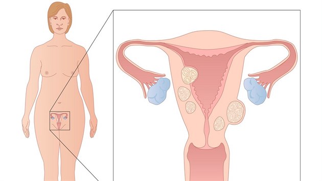 Obrzek ukazuje myomy ve stn dlohy.