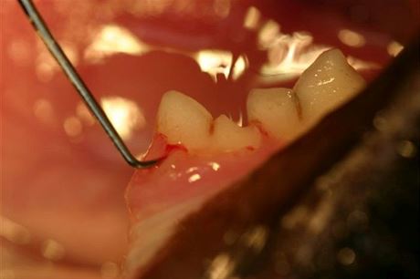 Na obrzku je ukzka identifikace defektu krku zubu pomoc periodontln sondy...