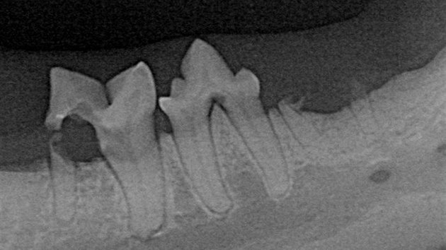 Tento rentgenov snmek ukazuje ztrtu denzity zubu doln elisti (zub vlevo) a koenov fragmenty zubu s chybjc korunkou (zub vpravo).