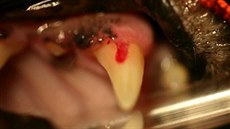 Nejprve se zdá, e tká dásn jakoby roste do zubu nebo zakrývá základnu zubu.
