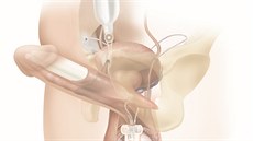 Nafukovací implantát stojí 275 tisíc korun a operace trvá zhruba dvě hodiny. Nafukovací implantát stojí 275 tisíc korun a operace trvá zhruba dvě hodiny.