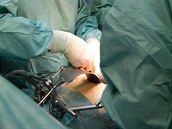 Transplantace dělohy je technicky velmi složitá. Děloha má velmi malé,... Transplantace dělohy je technicky velmi složitá. Děloha má velmi malé,...