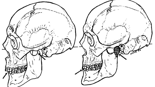 Stav po vyhojen odlomench kloubnch hlavic provzen mrnm otevenm frontln partie chrupu (vlevo) a pokus o stanoven pvodnho postaven elist krle Karla IV. ped razem (vpravo). Pvodn poloha hlavice je rafovan. Kraniogramy (dole) obliejovho skeletu po rentgenokefalometrick analze proveden doc. Dr. Z. mahelem v roce 1997 (text: Emanuel Vlek).