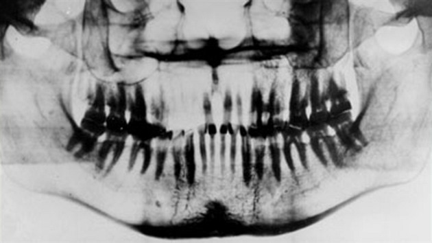 Remodelace kloubnch hlavic a zkrcen incisura mandibulae na panoramatickm rentgenogramu chrupu Karla IV. Na brad jsou vidt kondenzovan linie po vyhojench svislch zlomeninch a ztlutn corticalis na dolnm okraji tla mandibuly (text: Emanuel Vlek).