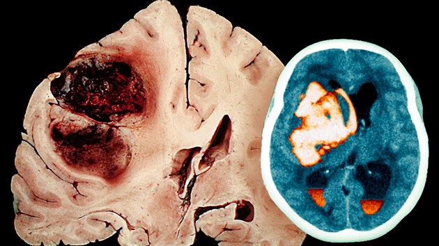 Snmek z CT pacienta s mozkovou mrtvic.
