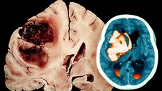 Snímek z CT pacienta s mozkovou mrtvicí.