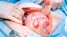 Operace pacientky s nádorem na vajeníku.