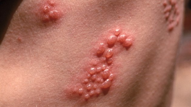 Psov opar zpsobuje infekce virem Varicella zoster (ilustran fotografie)