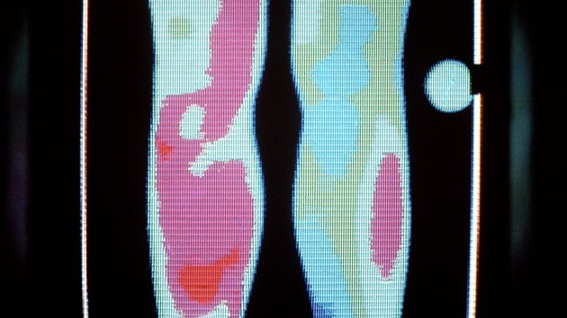 Termogram nohou ukazuje hlubokou iln trombzu v levm ltku.