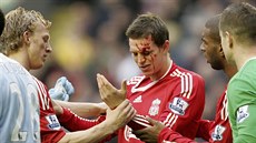 Liverpool - Manchester City: krvavé zranní ve tvái domácího Daniela Aggera