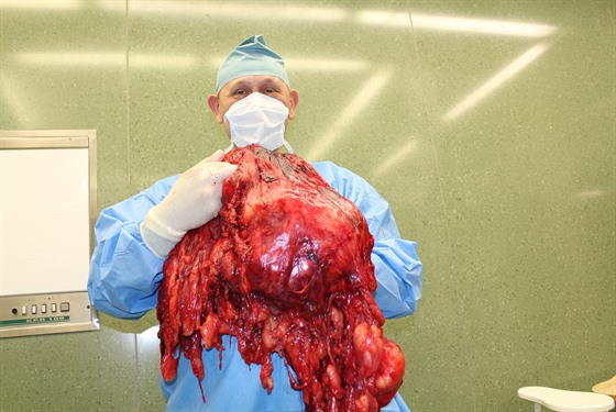 Lékai Krajské nemocnice Tomáe Bati ve Zlín odstranili obí nádor, váil 27...