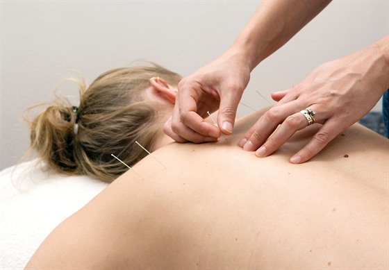 Jedna z léebných metod v ínské medicín je akupunktura (ilustraní fotografie)