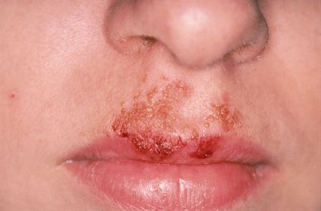 Impetigo