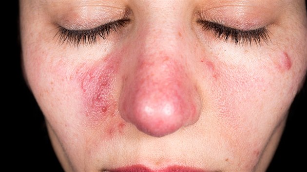 Rovka (rosacea)