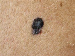 Tmavá barva znaménka je jeden z varovných signál. Na snímku je vidt melanom s...
