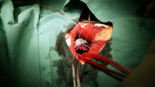 Operace srdce - ilustra�ní fotografie