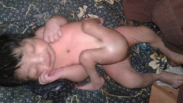 V Indii se narodil chlapec se tyma nohama a dvma penisy. Lkai mu pi nron operaci nadmrn konetiny odstranili.