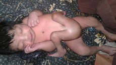 V Indii se narodil chlapec se tyma nohama a dvma penisy. Lékai mu pi...