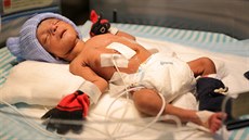 V Indii se narodil chlapec se čtyřma nohama a dvěma penisy. Lékaři mu při... V Indii se narodil chlapec se čtyřma nohama a dvěma penisy. Lékaři mu při...