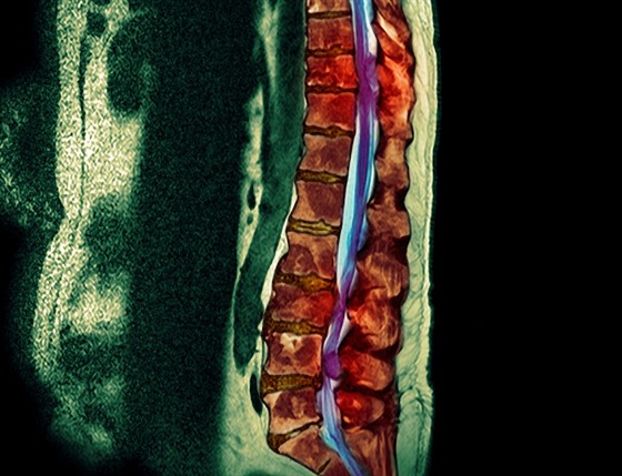 Snímek pacienta s metastázující rakovinou plic do kostí (ilustraní fotografie)