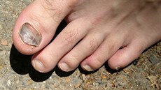Jak zamezit modrání nehtů a jak je případně ošetřit? Jak zamezit modrání nehtů a jak je případně ošetřit?