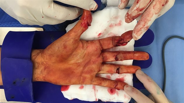 Tento snmek byl pozen ped operac Petry Kvitov, vidt jsou rny na vech prstech.