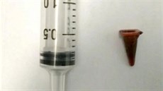 Malý dopravní kužel, který lékaři vytáhli z plic 47letého muže Malý dopravní kužel, který lékaři vytáhli z plic 47letého muže