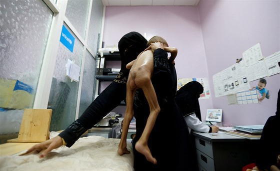 Na 3,3 milionu dtí v Jemenu trpí podvýivou.