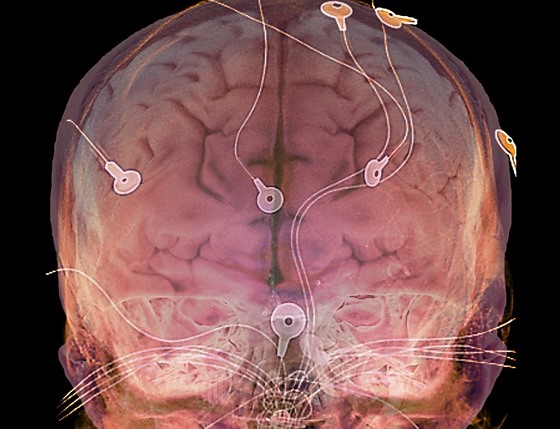 EEG neboli elektroencefalografie slouí k odhalení zmn v elektrické aktivit...
