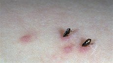 Blechy kočičí jako upíři sající na člověku. Blechy kočičí jako upíři sající na člověku.