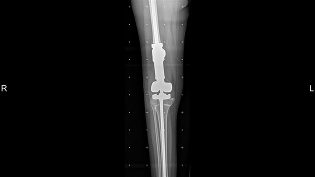Snmek nohy s implanttem. (19.11.2017)