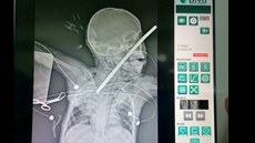 Dítě v Peru spadlo do studny a napíchlo se na tyč Dítě v Peru spadlo do studny a napíchlo se na tyč
