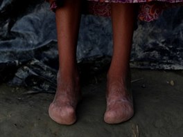 Rohinská dvanáctiletá dívka pózuje pro fotografa v bangladéském uprchlickém...