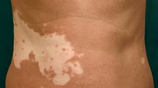 Svtlé nepravidelné skvrny na ki, odborn vitiligo, mohou být projevem...
