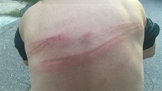 Snímek řidičových zad se stopami po ranách od násady smetáku Snímek řidičových zad se stopami po ranách od násady smetáku