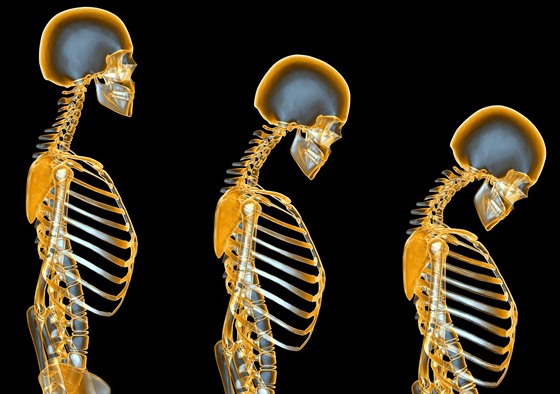 Osteoporóza (ilustraní snímek)