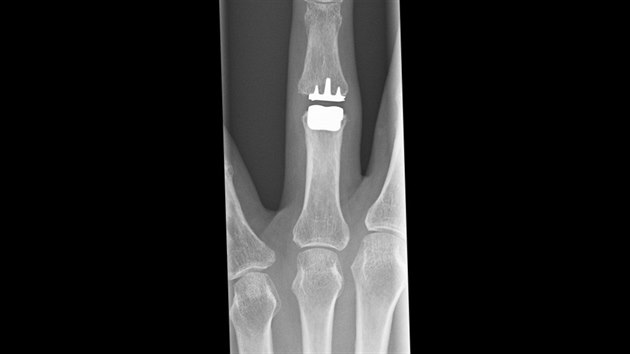 Lkai v Uherskm Hraditi provedli vmnu drobnho kloubu prstu ruky.