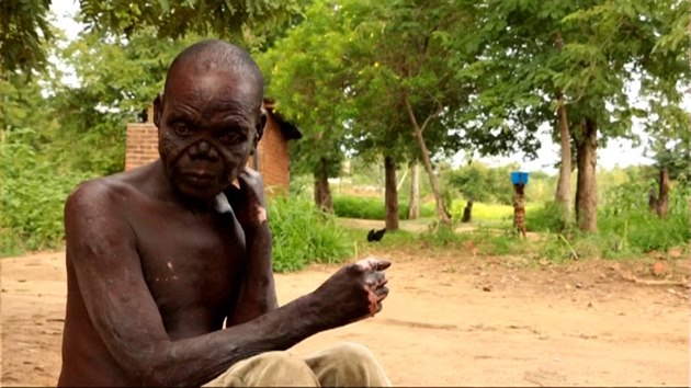 Lepra se vyskytla u několika pacientů v africkém Malawi