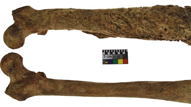Detailn pohled na musk stehenn kosti nalezen v mst bvalho olomouckho hbitova postien chronickou periostitidou zpsobenou konenou fz syfilidy.