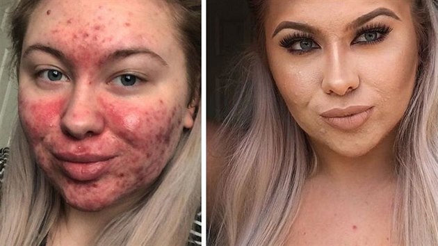 Abigail Collinsová tráví hodiny denně zakrýváním akné Abigail Collinsová tráví hodiny denně zakrýváním akné