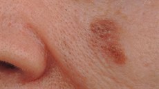 Nepravidelný melanom na oblieji, který je typický rozpitými okraji.